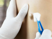 கொழுப்புகட்டிகள்… வருவதற்கான காரணங்களும் தீர்வுகளும்